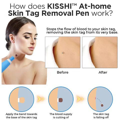 KISSHI™ At-home Skin Tag Removal Pen
