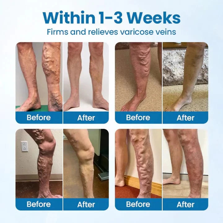 Lyyeto® VeinGuard Herbal Spray ACE -✅ Clinically proven to eliminate varicose veins in just 7 days!
