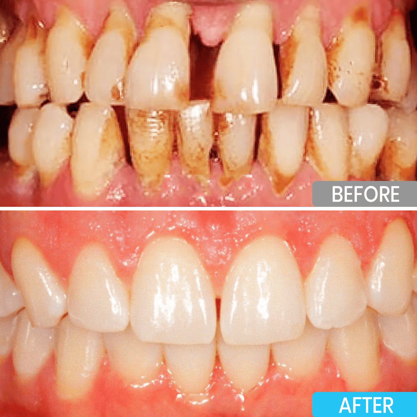⭐️Lyyeto® Focussmile bee venom treatment powder for oral use ACE 🦷