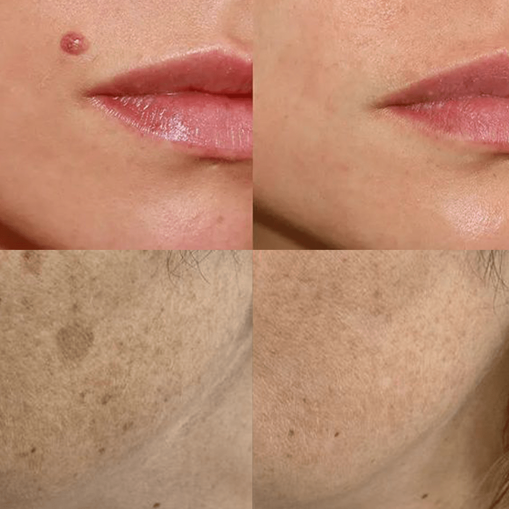 KISSHI™ Spotfree PLUS Professional Electric Cosmetic Pen