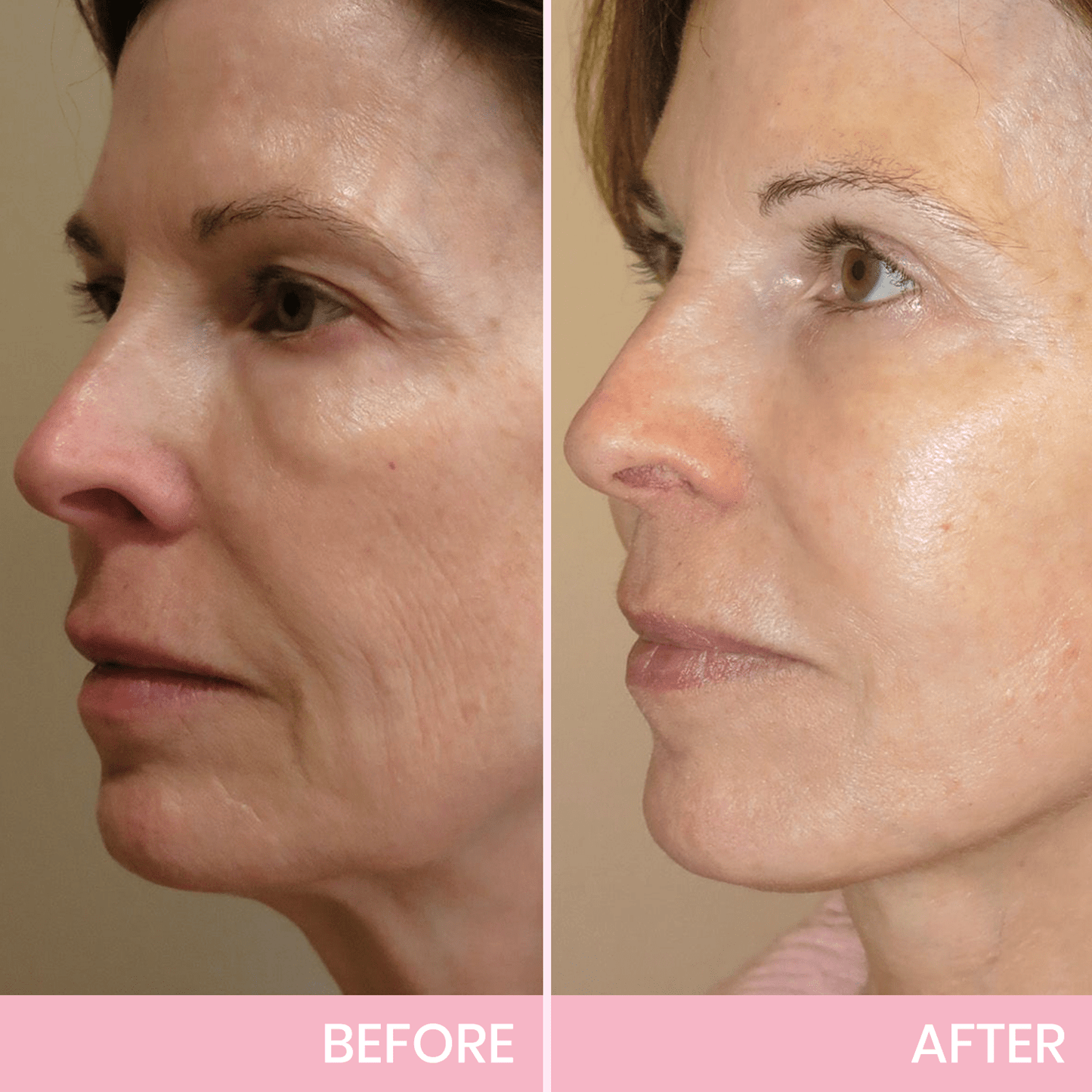 Luhaka™ V-Face Lifting Invisible Adhesive Tape 7
