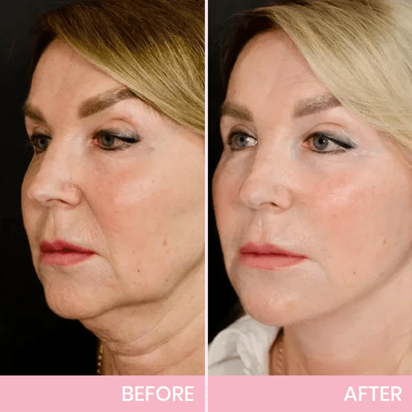 Luhaka™ V-Face Lifting Invisible Adhesive Tape 7