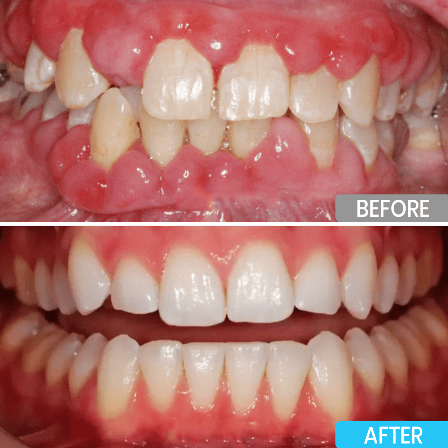 ⭐️Lyyeto® Focussmile bee venom treatment powder for oral use ACE 🦷