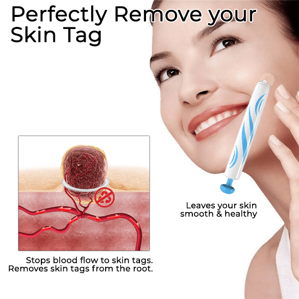 KISSHI™ At-home Skin Tag Removal Pen