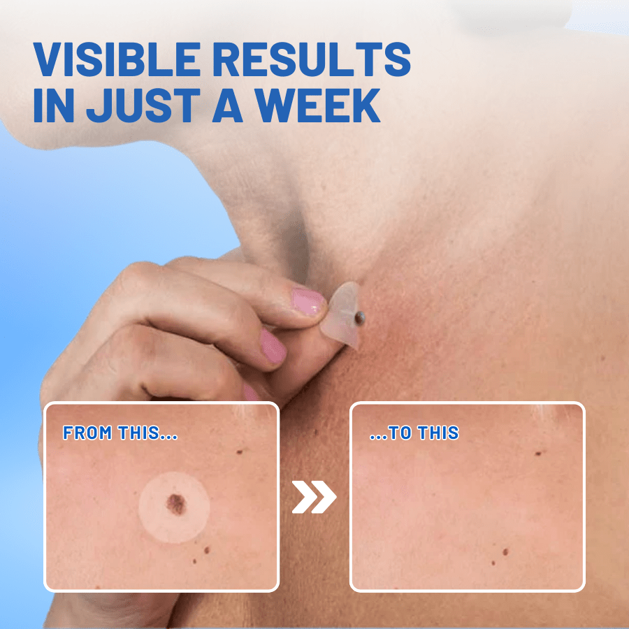 KISSHI™ Moles & Warts Removing Skin Tag Patch