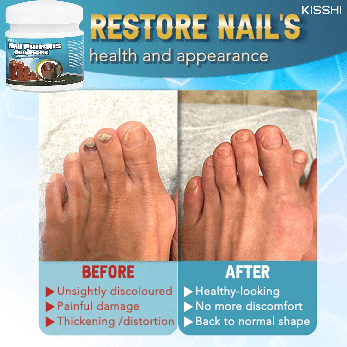 Kisshi™ 5X Quick-healing Nail Fungus Ointment👨🏼⚕️British Dermatologist Approved