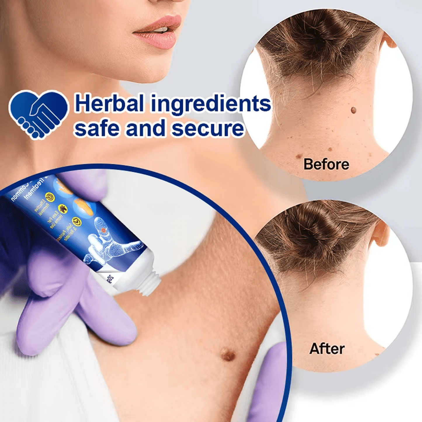 Kisshi™ WartsOff Instant Blemish Removal Cream