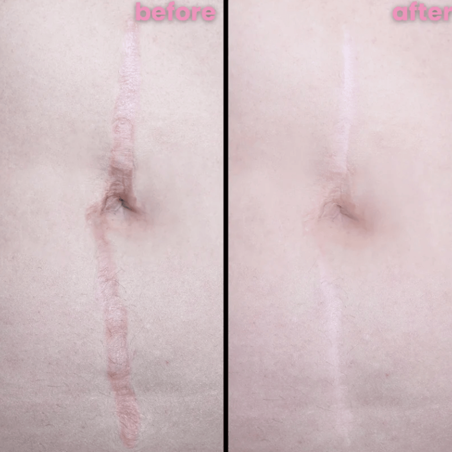 Luhaka™ Silicone Scar & Wrinkle Tape 2
