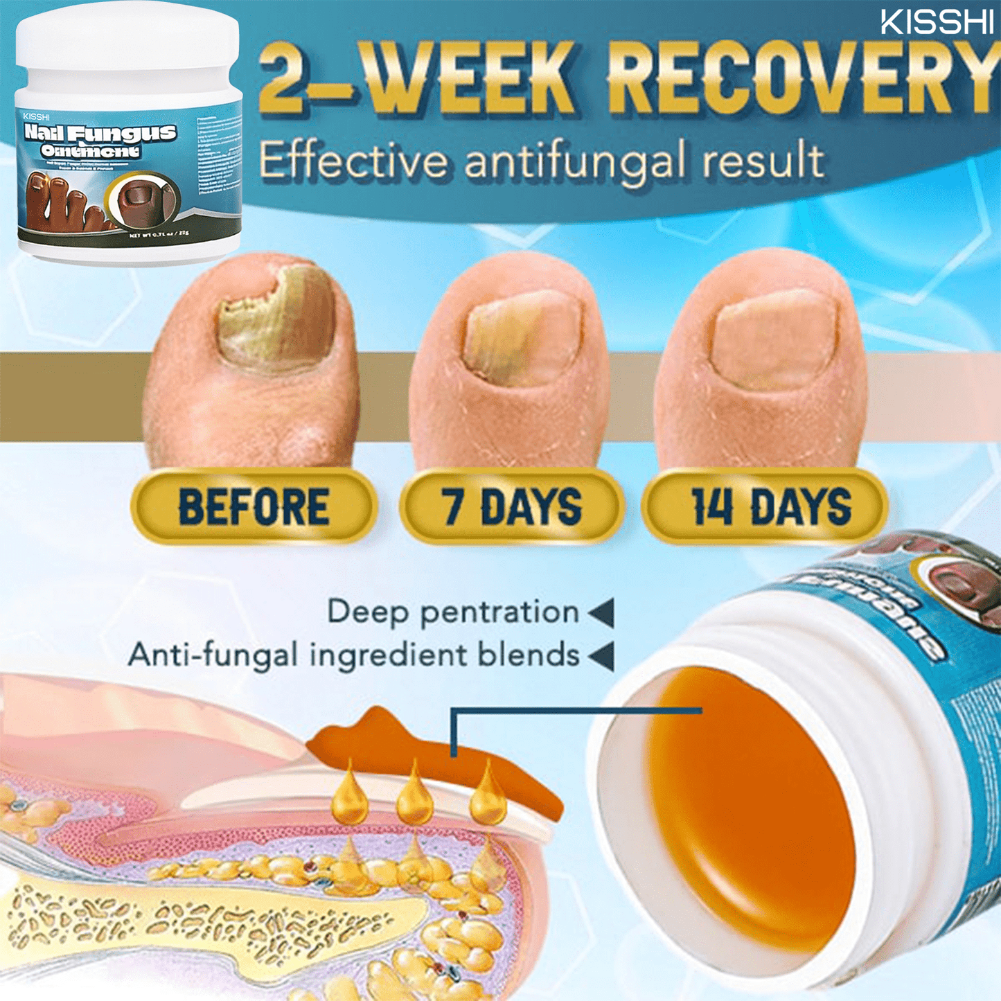 Kisshi™ 5X Quick-healing Nail Fungus Ointment👨🏼⚕️British Dermatologist Approved