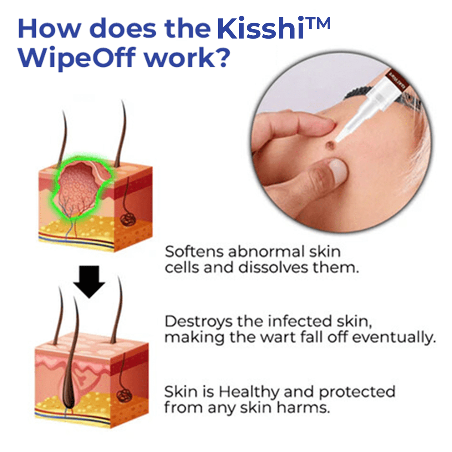 Kisshi™ WipeOff Tags & Moles Remover