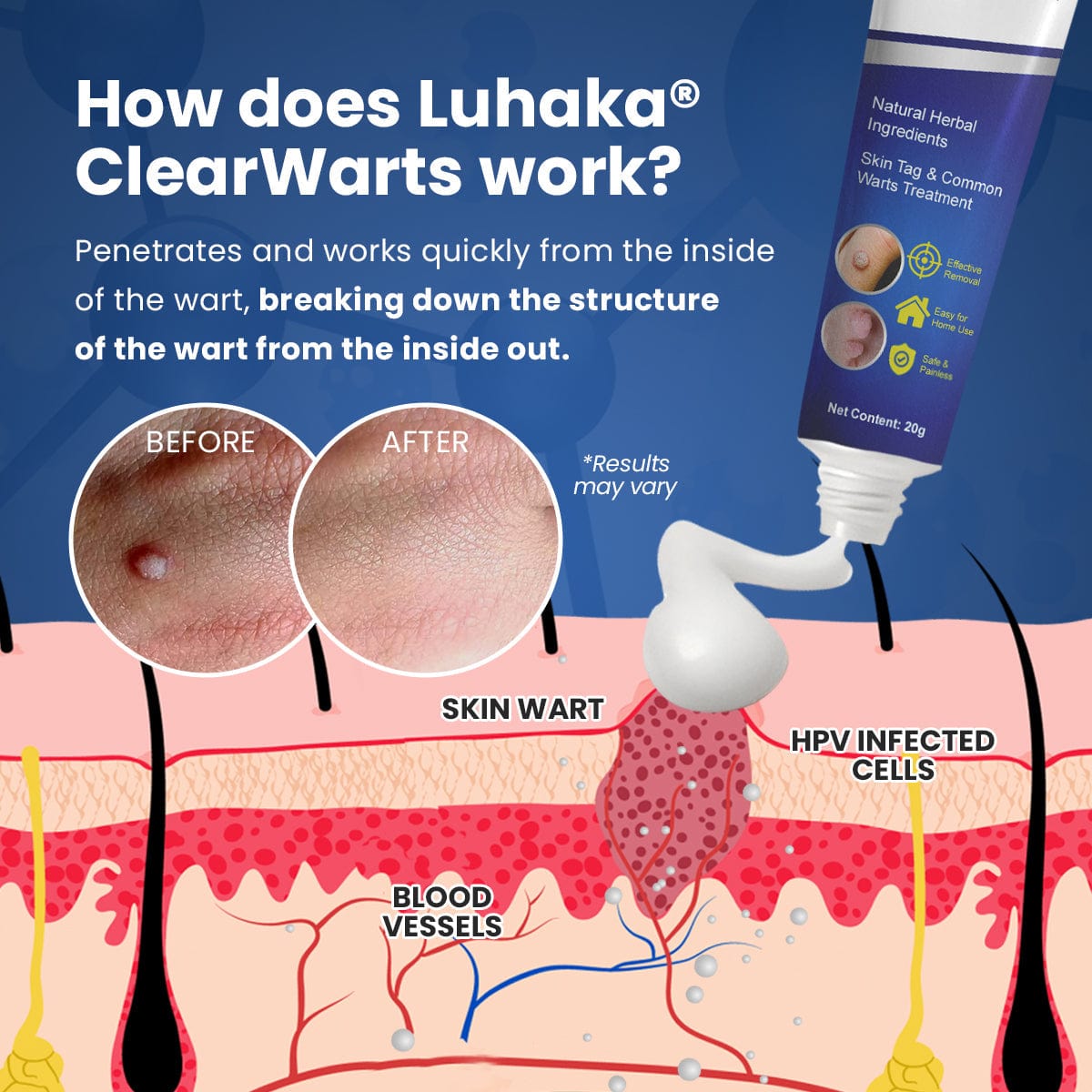 Luhaka® ClearWarts Instant Blemish Removal Cream