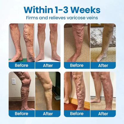 Lyyeto® VeinGuard Herbal Spray ACE 1  -✅ Clinically proven to eliminate varicose veins in just 7 days!