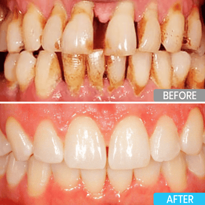 ⭐️Lyyeto® Focussmile bee venom treatment powder for oral use ACE 🦷