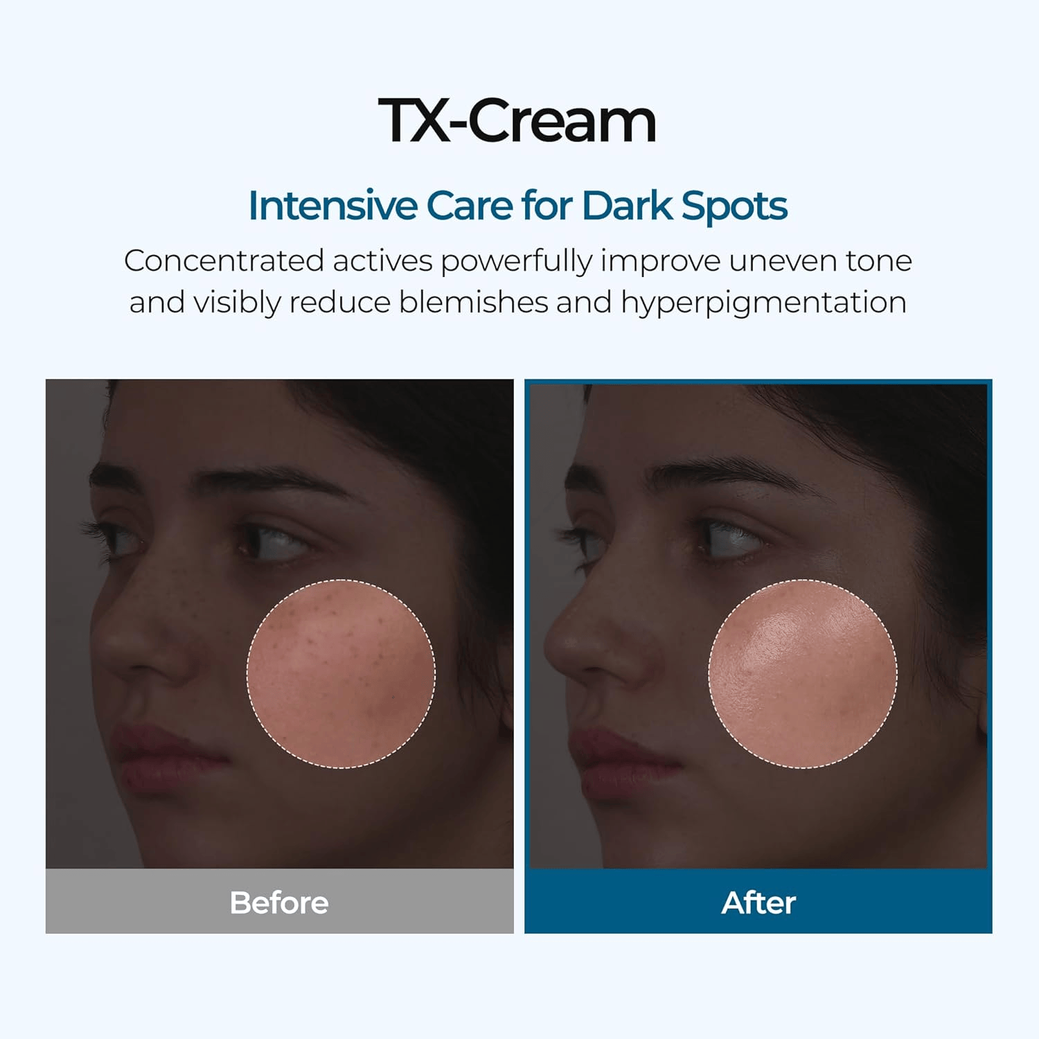 DR.Malexin TX Tranexamic Acid CREAM | Skin freckle Cream, Blemishes, Anti-pigmetation korean skin care | Korean Cosmetics | 1.7 fl oz (50 ml)