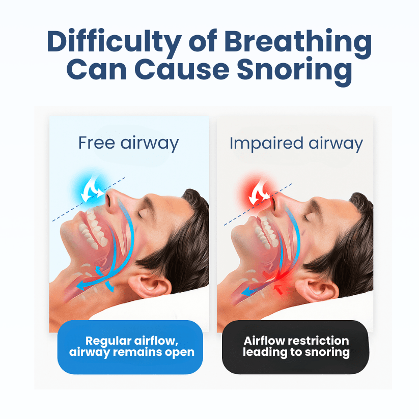Lyyeto® Snoreless Nasal Breather ACE 1