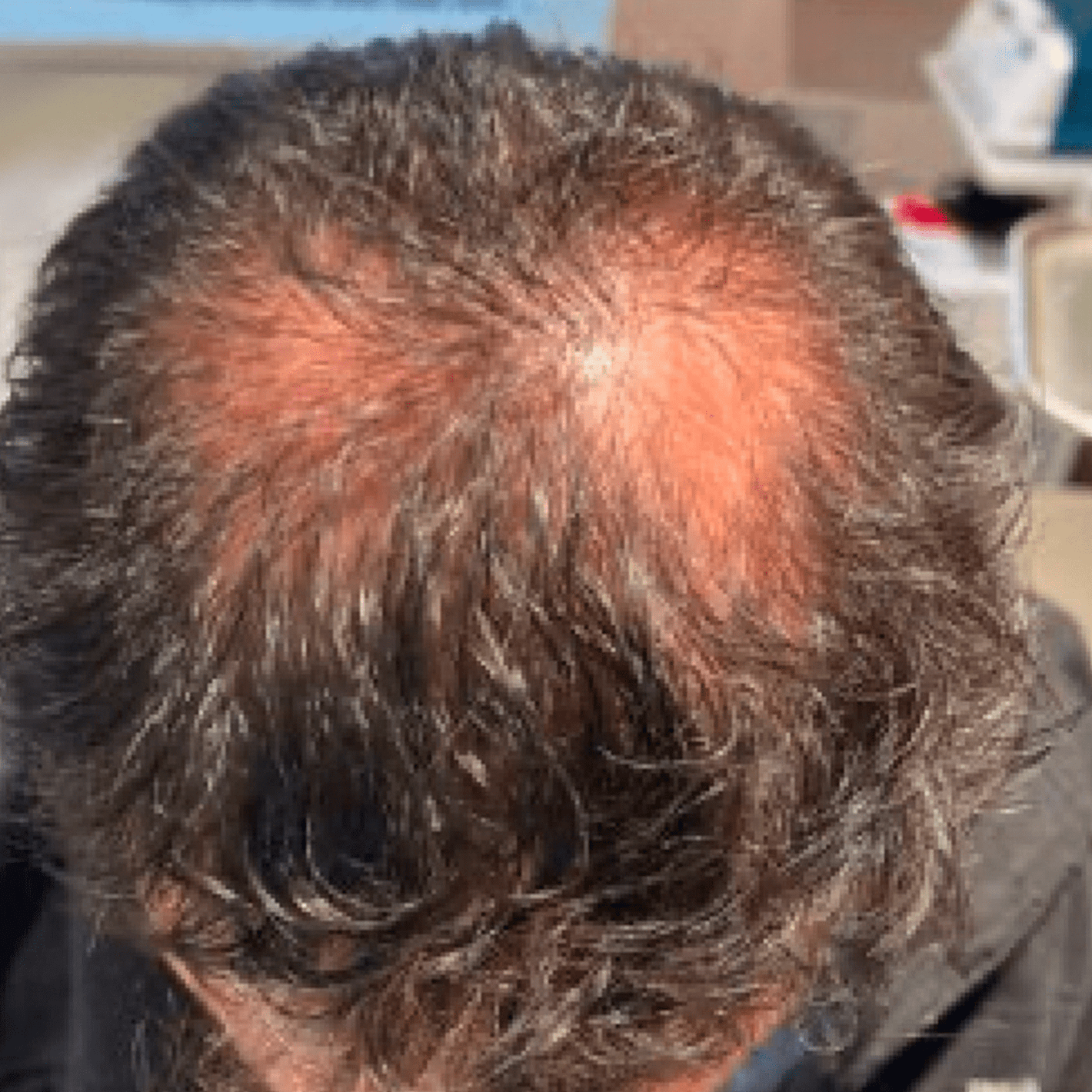 Lyyeto® HairRevix Advanced Hair Restoration Liquid Pearl 25 Lyyeto® HairRevix Advanced Hair Restoration Liquid Pearl