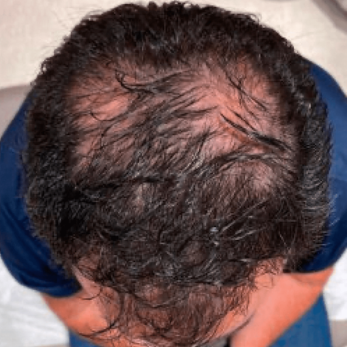 Lyyeto® HairRevix Advanced Hair Restoration Liquid Pearl 26 Lyyeto® HairRevix Advanced Hair Restoration Liquid Pearl