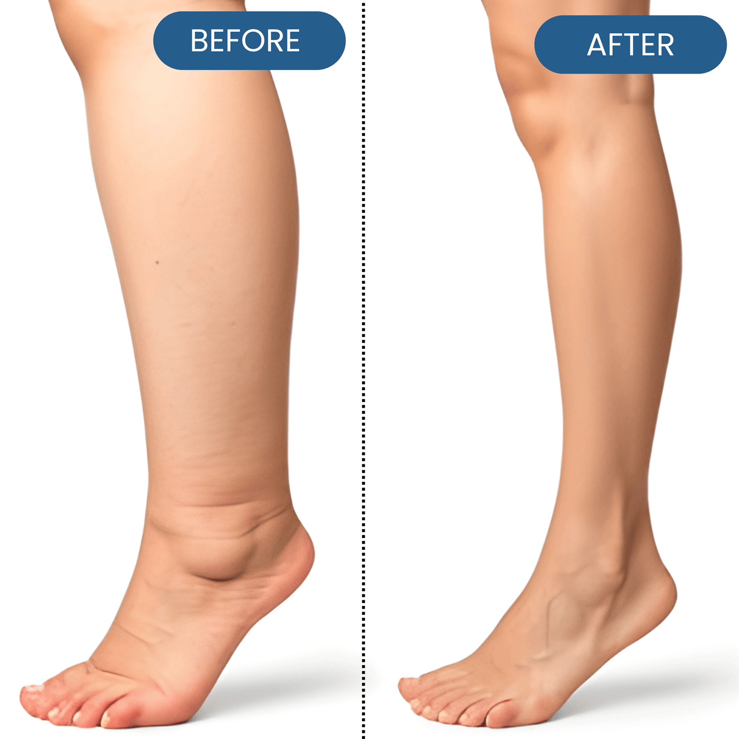 Lyyeto® Swelling Relief Roll-on Cooling Cream