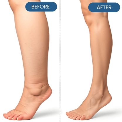 Lyyeto® Swelling Relief Roll-on Cooling Cream