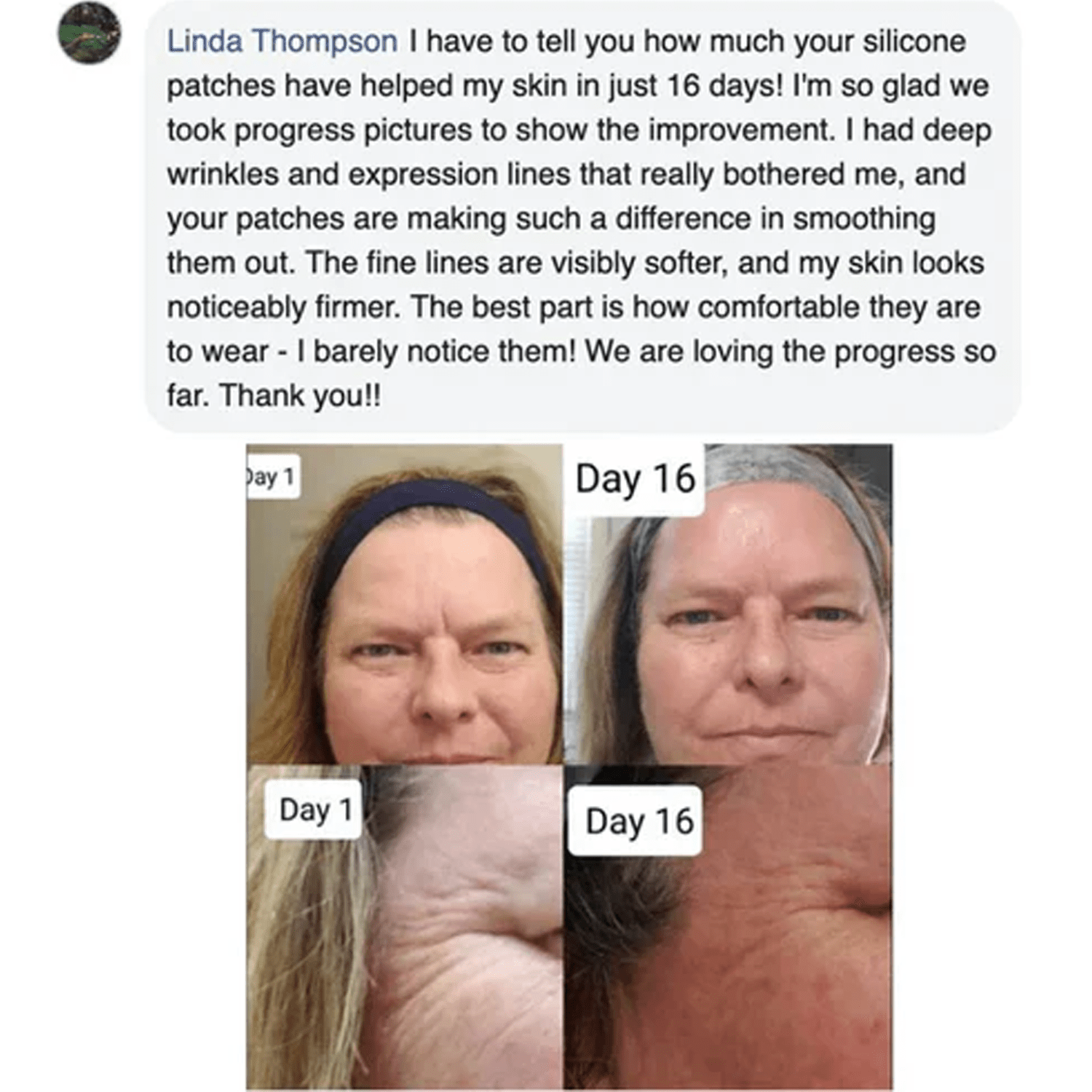 Luhaka™ Silicone Scar & Wrinkle Tape 1