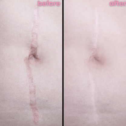 Luhaka™ Silicone Scar & Wrinkle Tape ACE 2