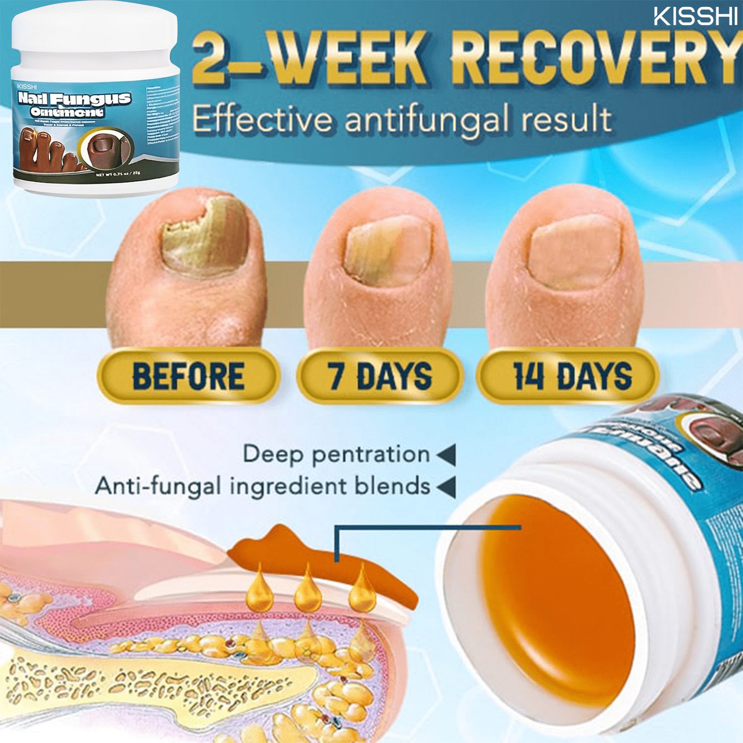 Kisshi™ 5X Quick-healing Nail Fungus Ointment👨🏼‍⚕️British Dermatologist Approved