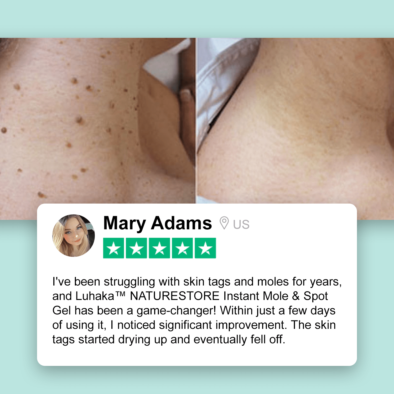 ✅ Official Store: Luhaka™ NATURESTORE Instant Mole & Spot Gel