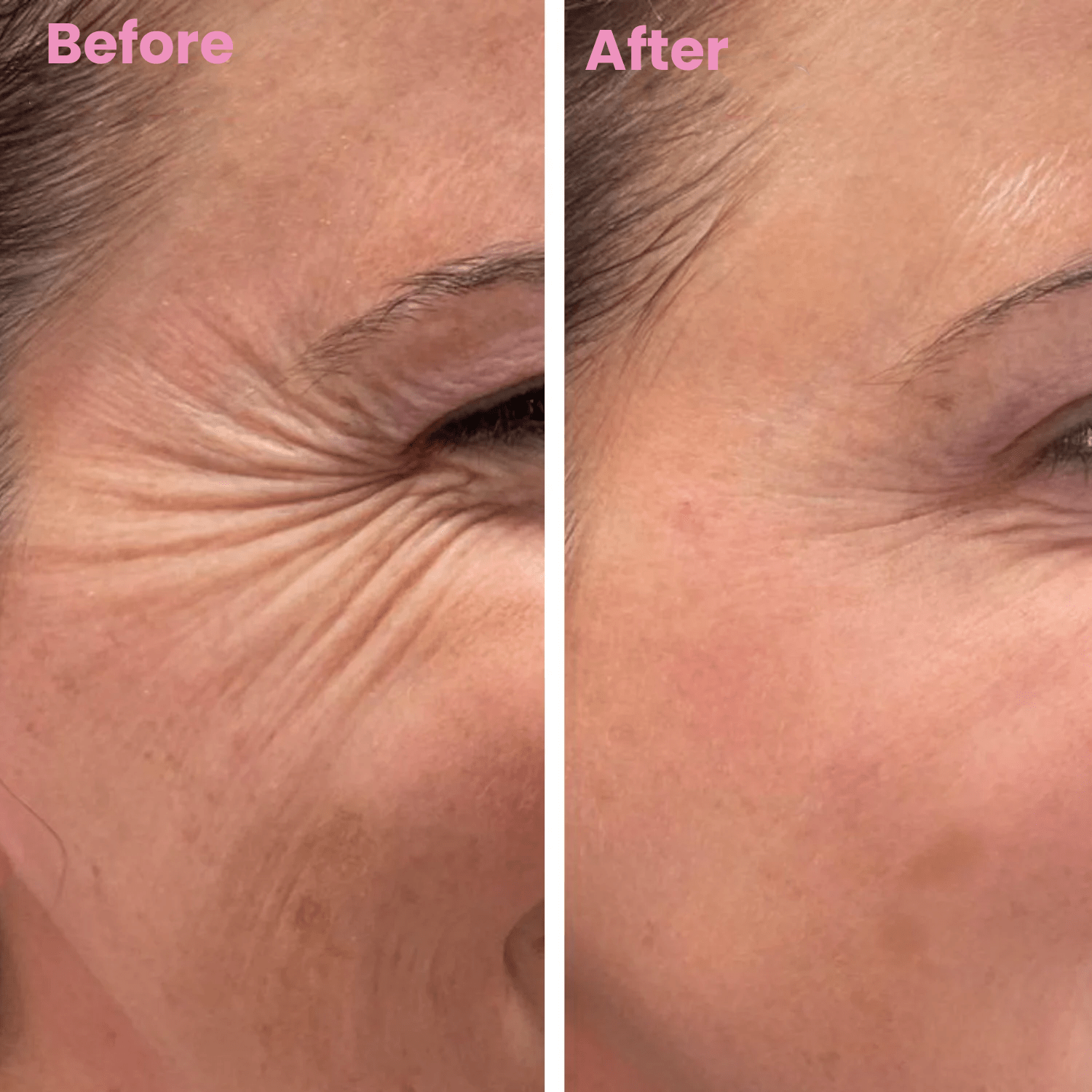 Luhaka™ Silicone Scar & Wrinkle Tape 1