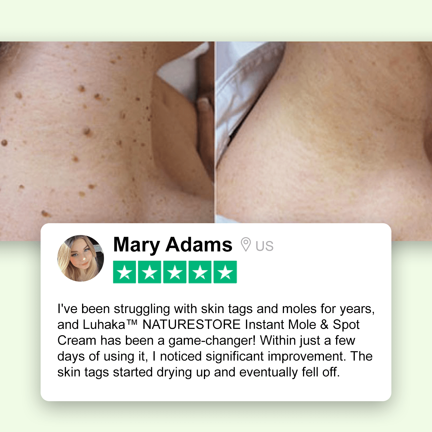 ✅Official Store: Luhaka™ NATURESTORE Instant Mole & Spot Cream