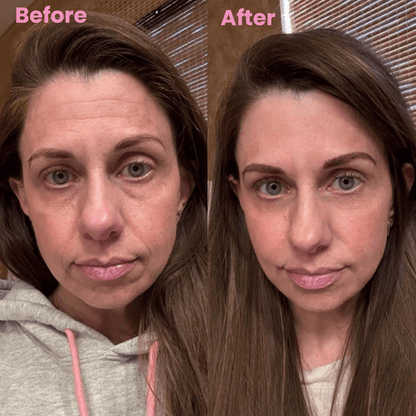Luhaka™ Silicone Scar & Wrinkle Tape ACE 2