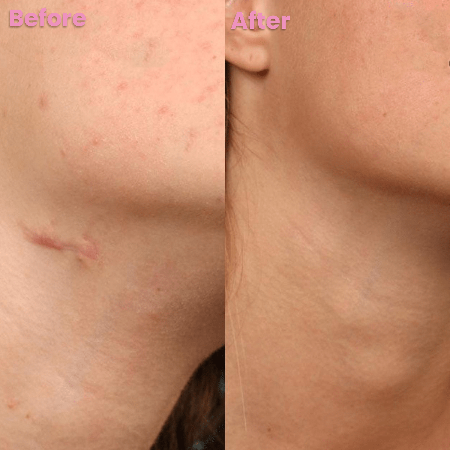 Luhaka™ Silicone Scar & Wrinkle Tape 1