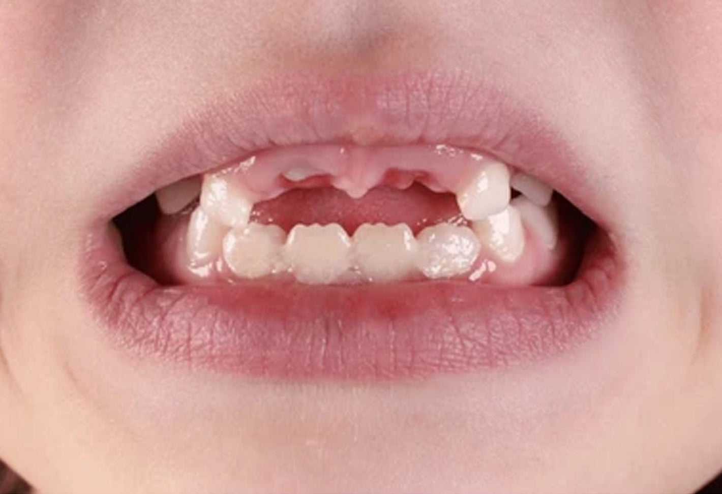 Mega Sale LUHAKA™ Silicone Reline Denture Set 18 Untitled 1 00dff379 24f8 46bc a117 6ac48f6016ec