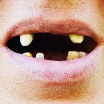 Mega Sale LUHAKA™ Silicone Reline Denture Set 15 Untitled 1 a37eec38 5097 4b7d 8d45 eb142fa208ef