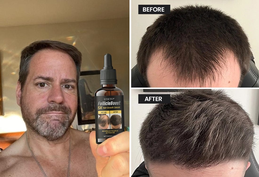 Lyyeto® FollicleBoost 5X Hair Growth Serum