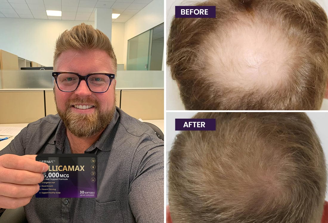 Luhaka™ FollicaMax 25,000 MCG Hair Growth Support 33 beforeandafter 2 78b14f50 0aa2 4024 844a 898739efc6bc