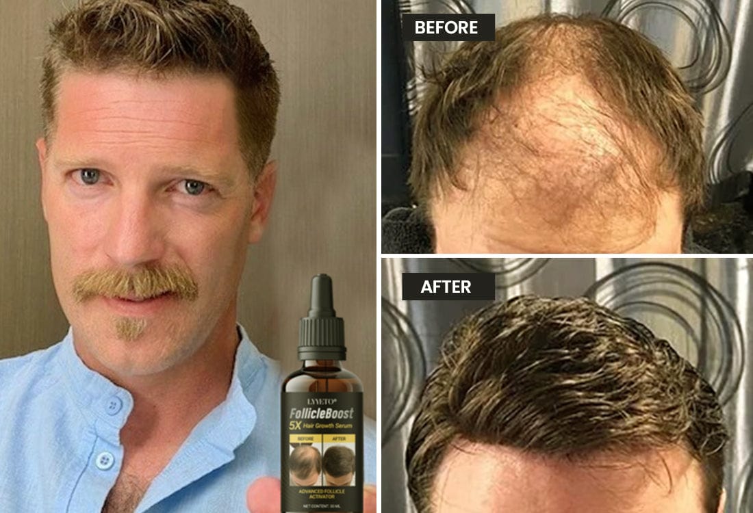 Lyyeto® FollicleBoost 5X Hair Growth Serum