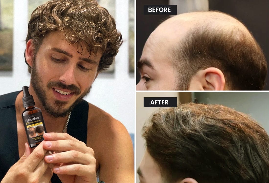 Lyyeto® FollicleBoost 5X Hair Growth Serum