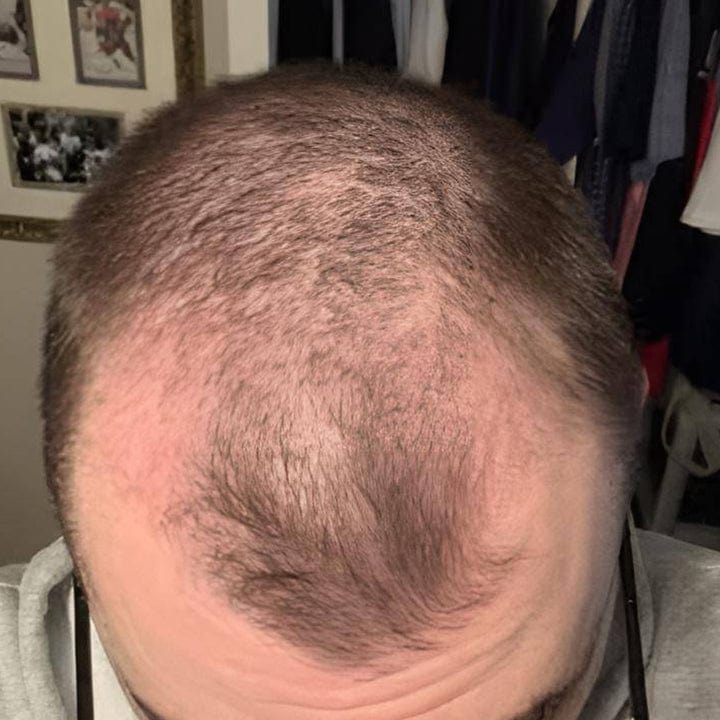 Luhaka™ FollicaMax 25,000 MCG Hair Growth Support 36 journey 1