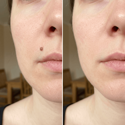 🌟 Luhaka® 2-in-1 Microneedle & Hydrocolloid Patch 🌿 A Dual-Action Solution for Face & Body Care—Helps Improve the Look of Moles, Acne, Flat Warts, Skin Tags, Wrinkles, Scars, and Other Common Skin Concerns ace 1
