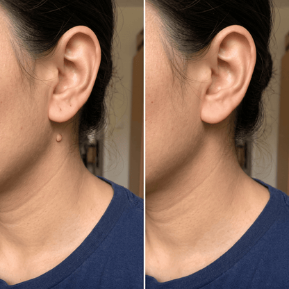 🌟 Luhaka® 2-in-1 Microneedle & Hydrocolloid Patch 🌿 A Dual-Action Solution for Face & Body Care—Helps Improve the Look of Moles, Acne, Flat Warts, Skin Tags, Wrinkles, Scars, and Other Common Skin Concerns ace 1