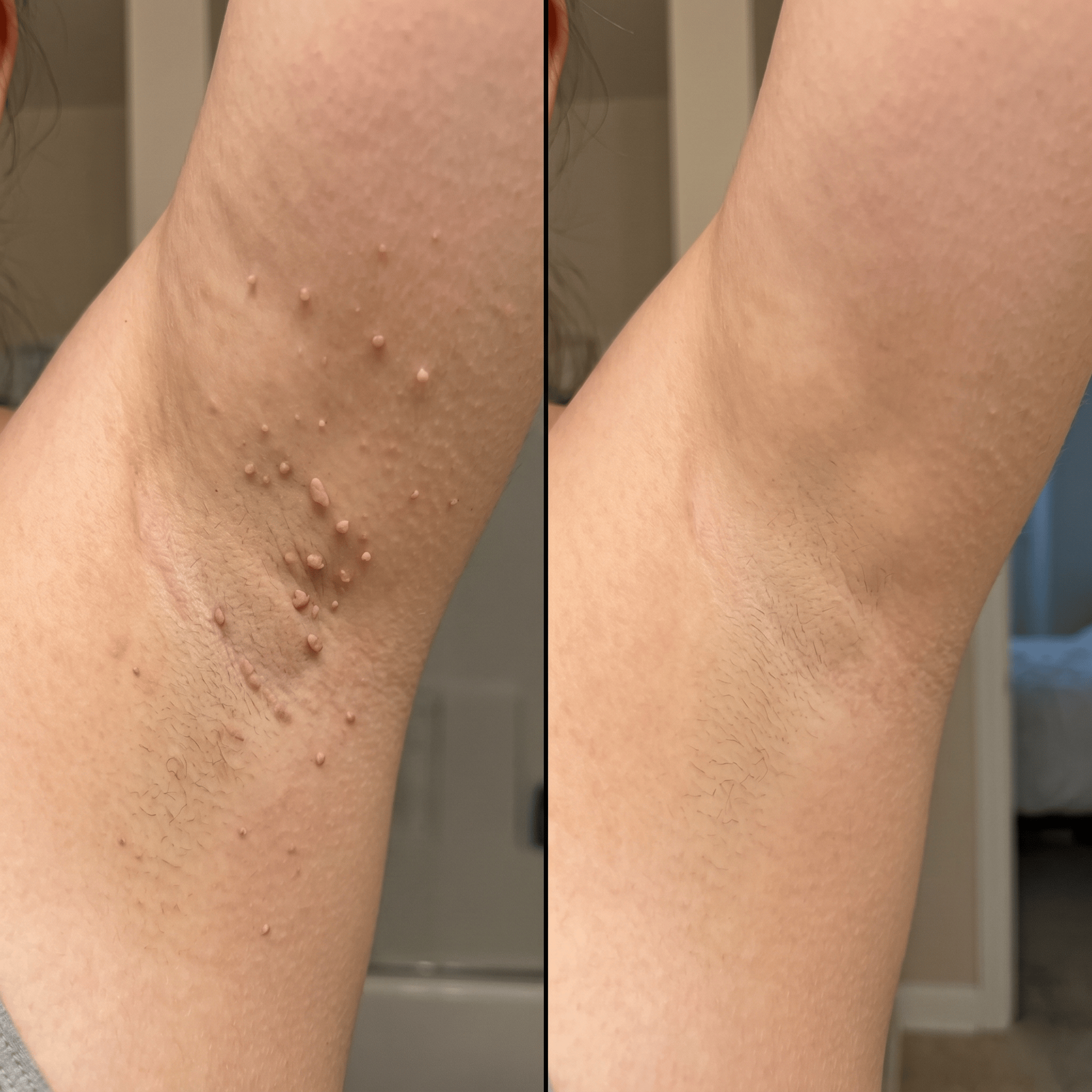 🌟 Luhaka® 2-in-1 Microneedle & Hydrocolloid Patch 🌿 A Dual-Action Solution for Face & Body Care—Helps Improve the Look of Moles, Acne, Flat Warts, Skin Tags, Wrinkles, Scars, and Other Common Skin Concerns ace 1