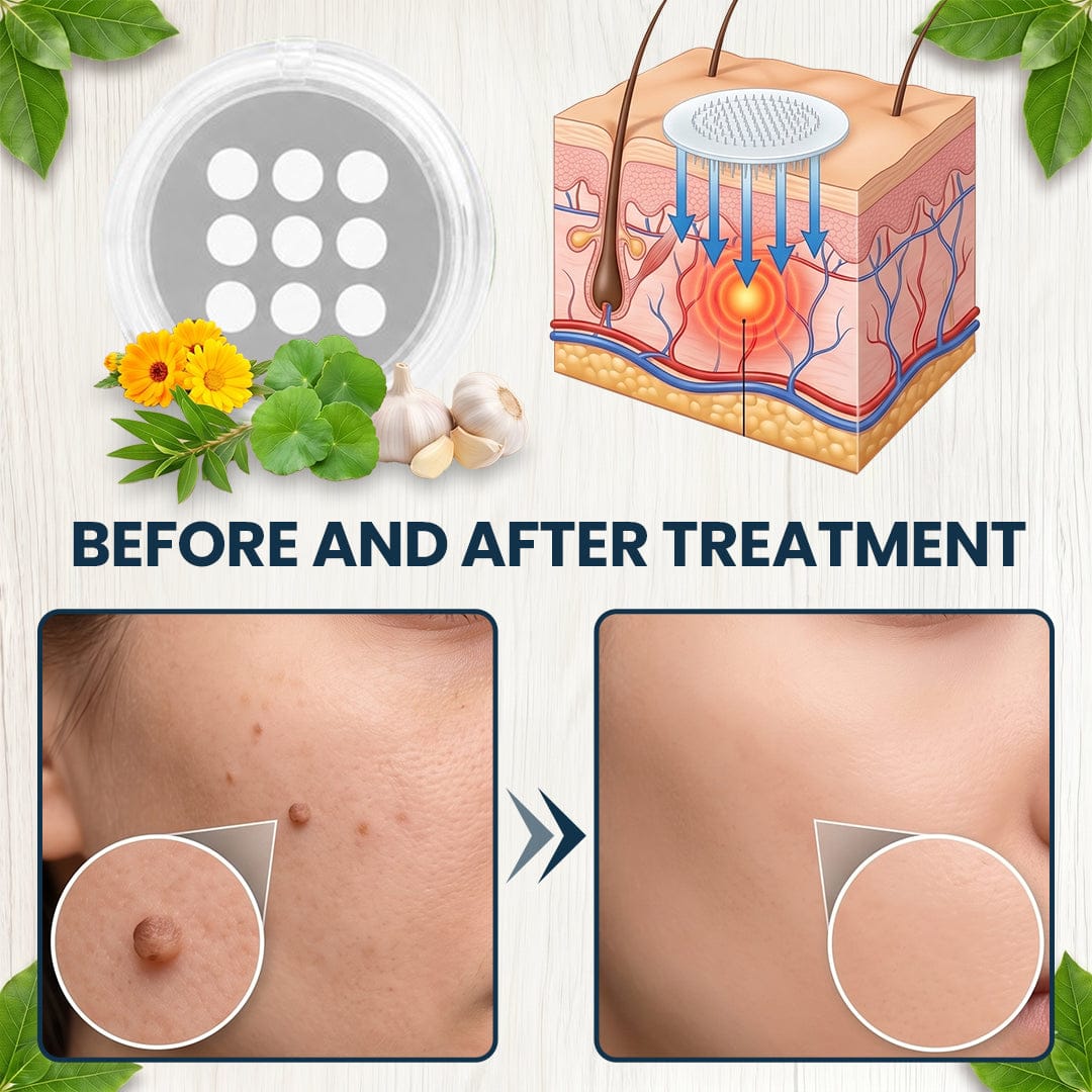 🌟 Luhaka® 2-in-1 Microneedle & Hydrocolloid Patch 🌿 A Dual-Action Solution for Face & Body Care—Helps Improve the Look of Moles, Acne, Flat Warts, Skin Tags, Wrinkles, Scars, and Other Common Skin Concerns ace 1