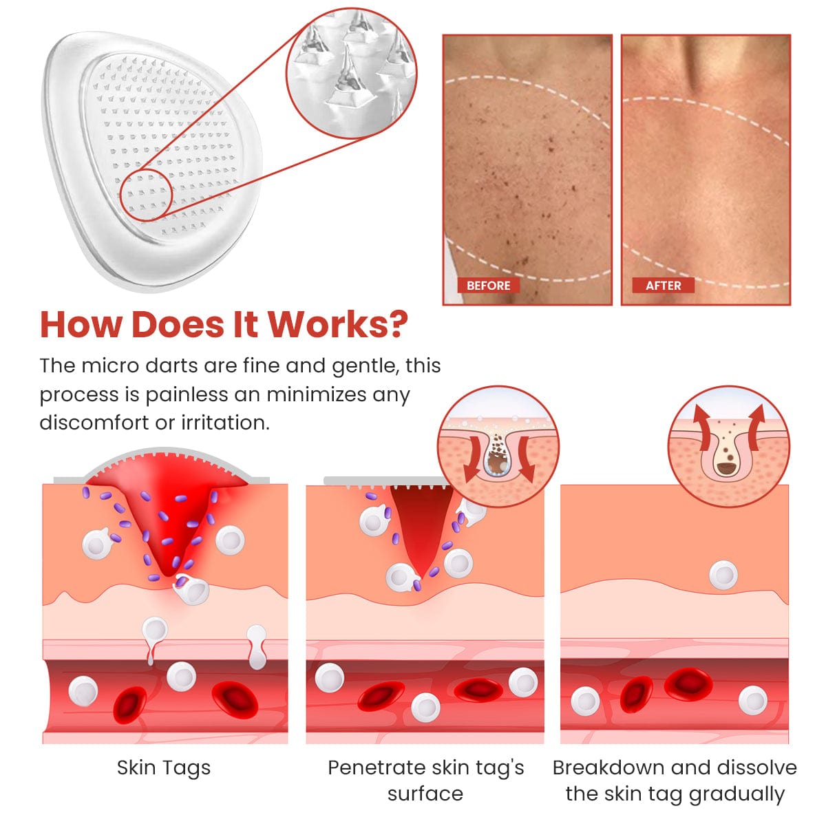 Luhaka® DermaSmooth Skin Tag Remover Patch