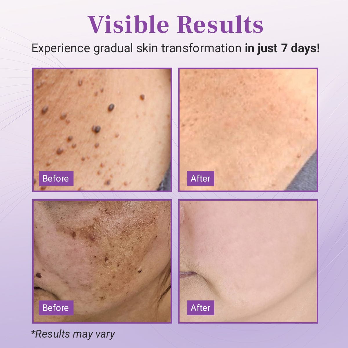Luhaka® DermaClear Mole and Dark Spot Removal Bio-Gel💞3