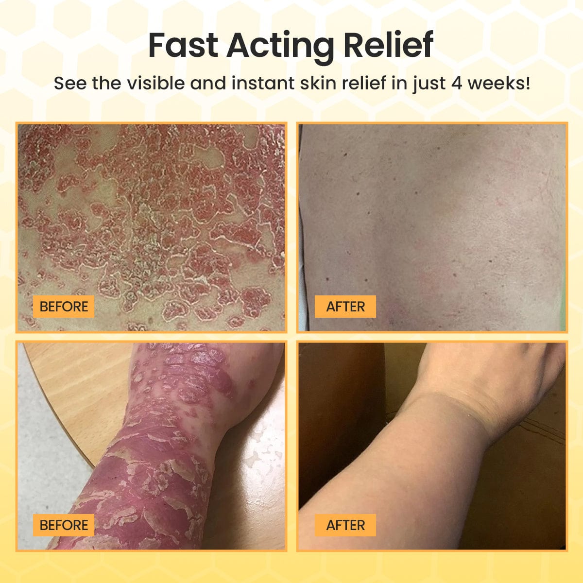 Luhaka® Bee Venom Psoriasis Cream
