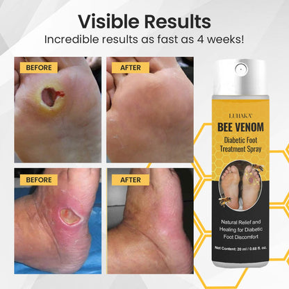 Luhaka™ Bee Venom Diabetic Foot Treatment Spray