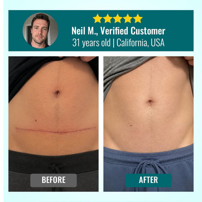 Luhaka® Advanced 3-in-1 Scar Repair Microneedle Patch 🏆1