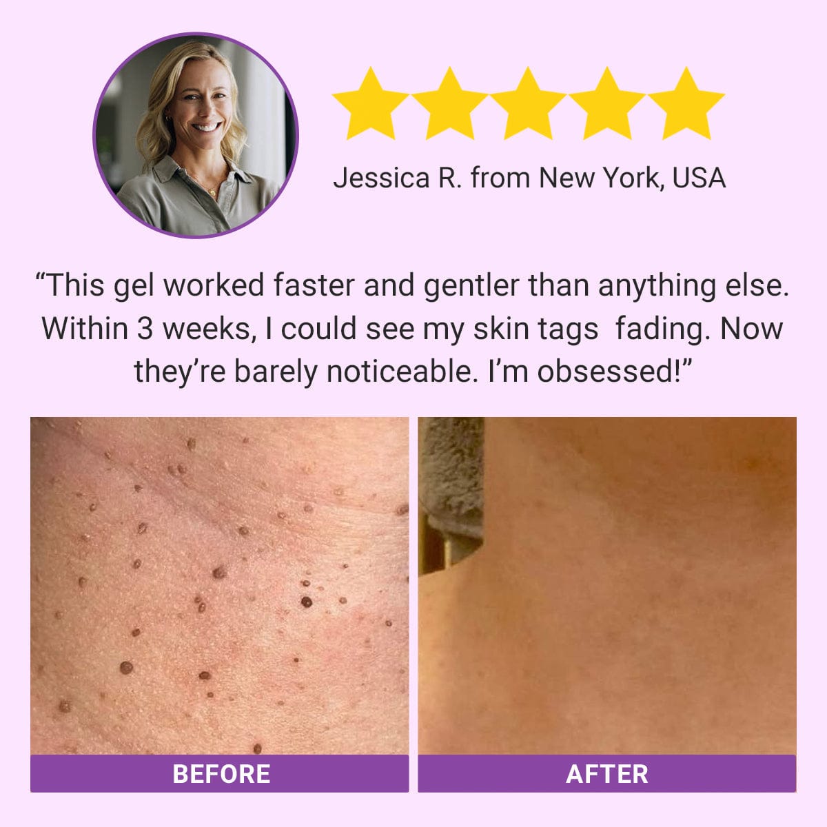Luhaka® DermaClear Mole and Dark Spot Removal Bio-Gel💞3