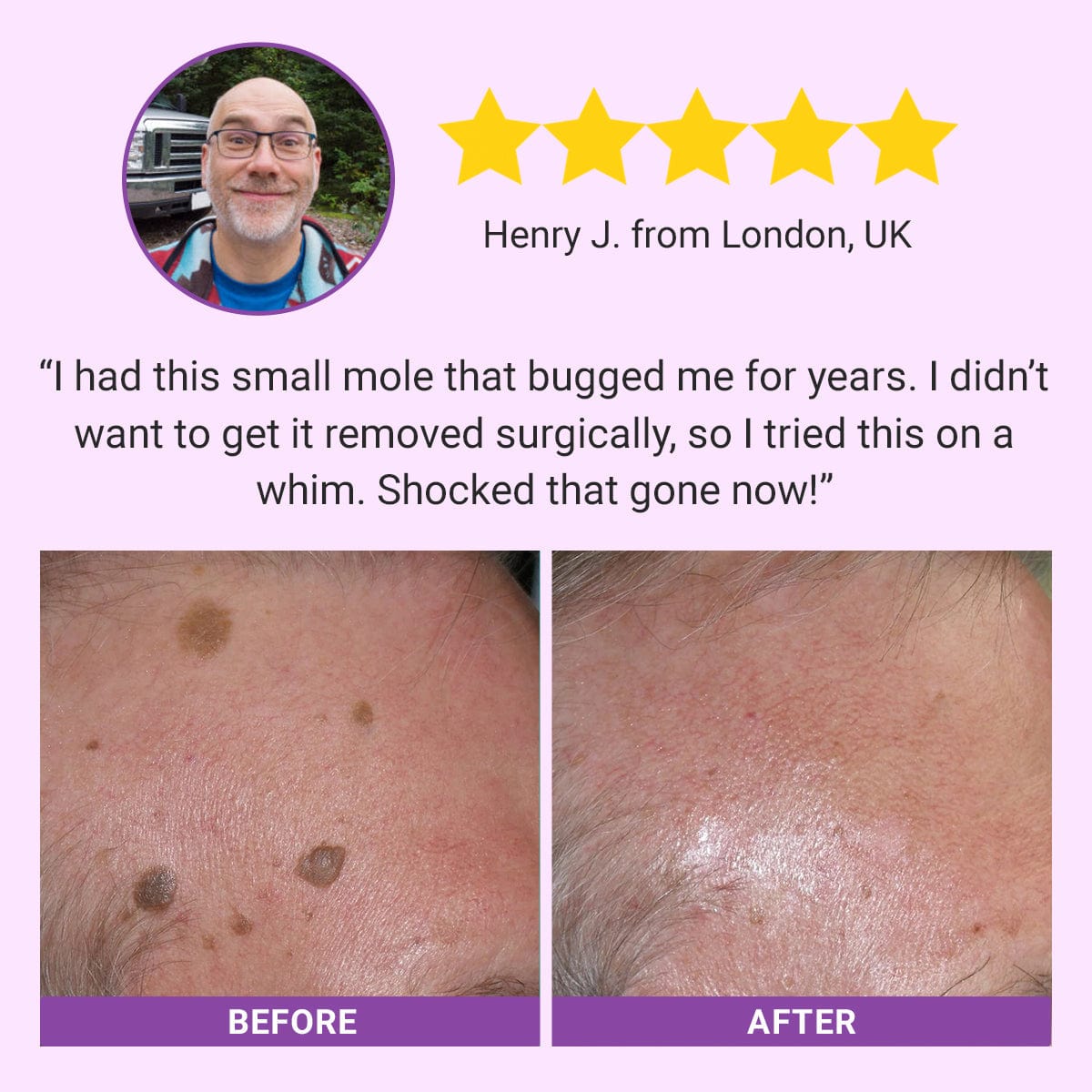 Luhaka® DermaClear Mole and Dark Spot Removal Bio-Gel💞3