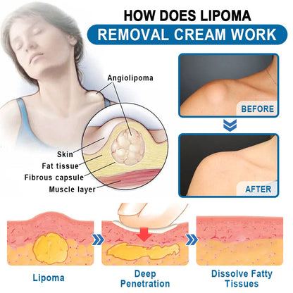 KISSHI™ Lipoma Removal Cream